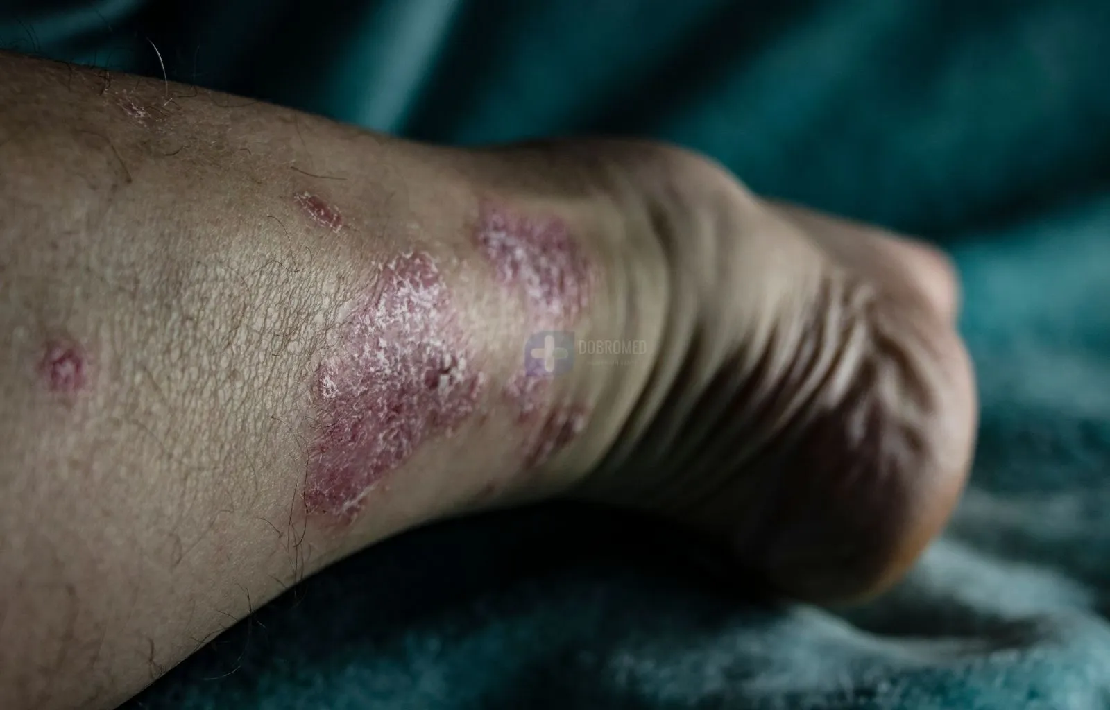 Консультация нарколога по кодированию при сопутствующих заболеваниях